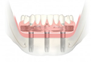 ImplantTrefoil