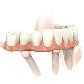 allegro implants dentaires