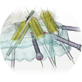 allegro implants dentaires